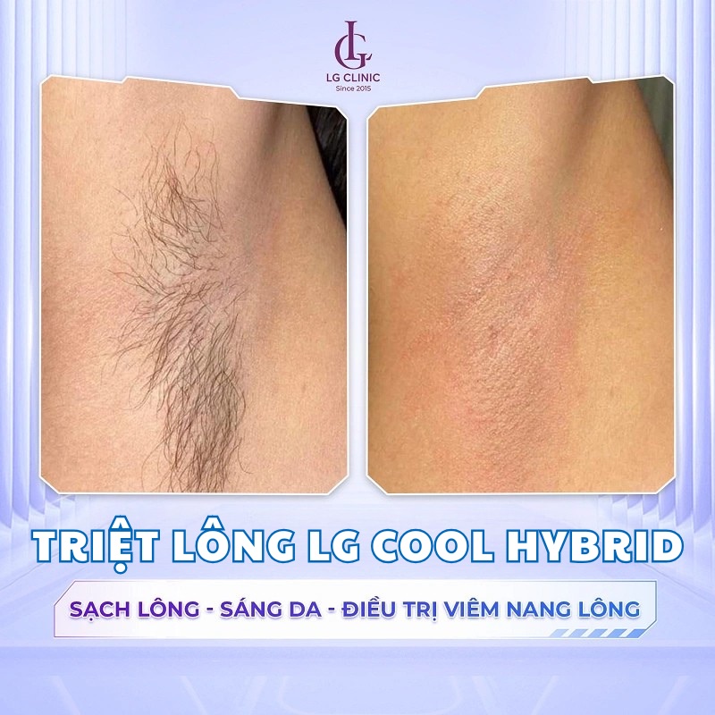 hình ảnh triệt lông vùng nách của khách hàng tại lg clinic