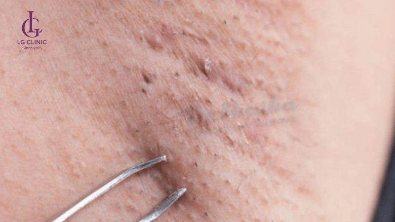 không nhổ lông trước triệt