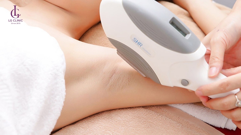 So sánh hiệu quả triệt lông OPT SHR và Diode Laser