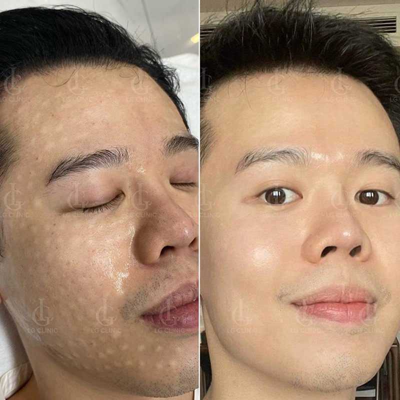 hấp trắng da mặt