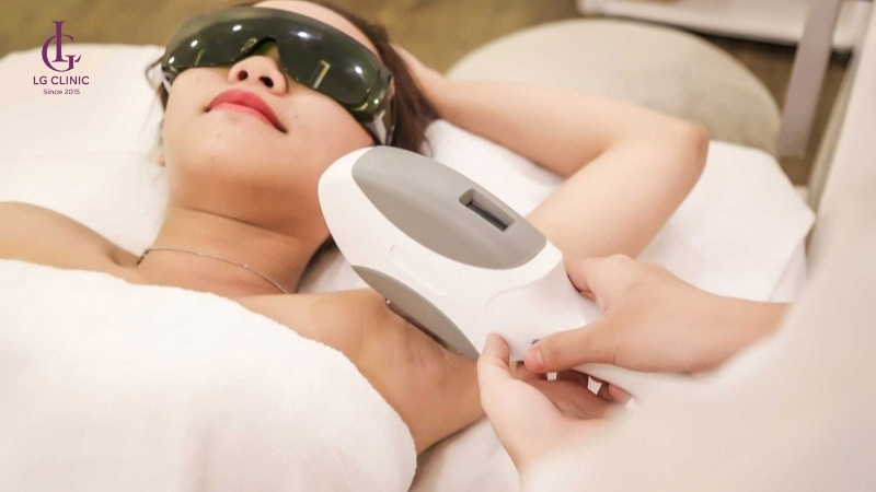 Hiệu quả triệt lông OPT SHR cho làn da mịn màng