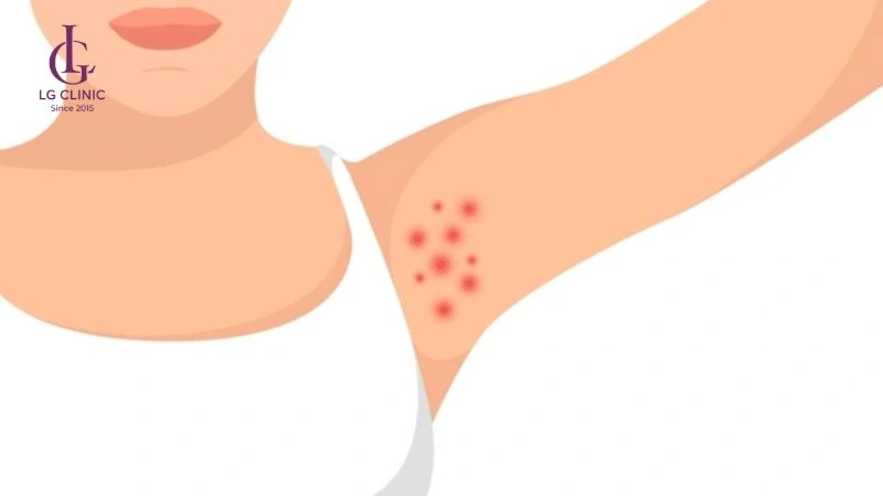 Tại sao nhổ lông nách bị nổi hạch