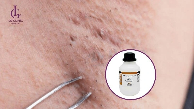 da nách bị sần sùi sau khi nhổ lông