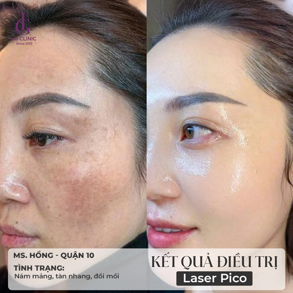 ảnh trước sau điều trị da