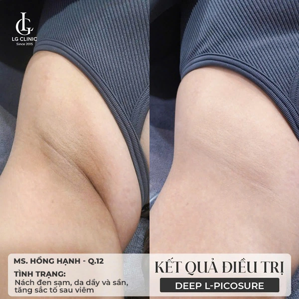 ảnh trước sau điều trị da