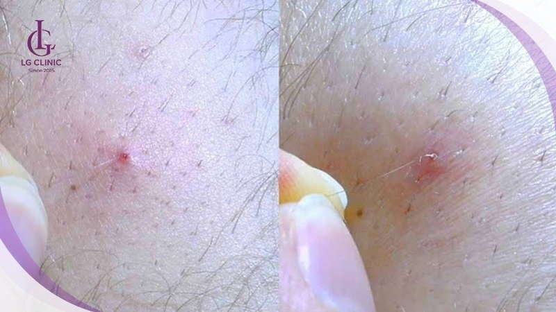 Cách cạo lông nách đúng cách