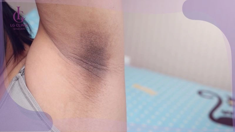 Cách cạo lông nách đúng cách