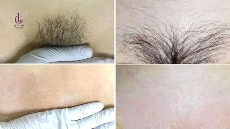 triệt lông vùng kín tại lg clinic
