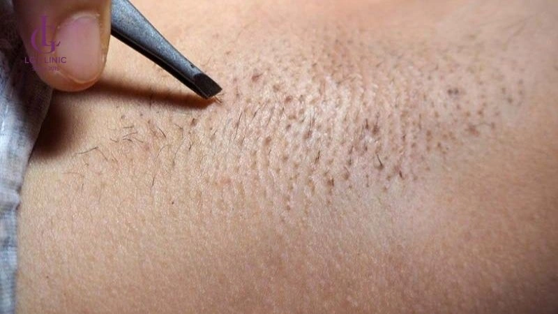 bầu có được nhổ lông nách không