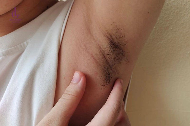 bầu có được nhổ lông nách không
