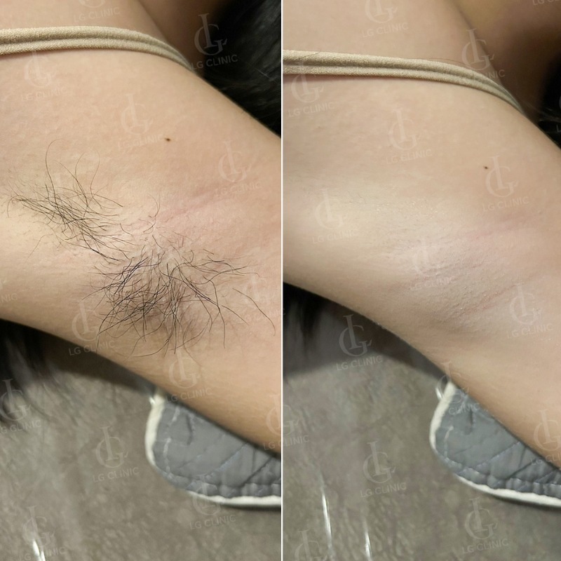 có nên nhổ lông nách không