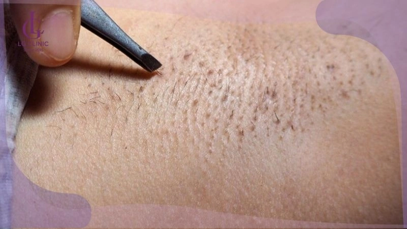có nên nhổ lông nách không