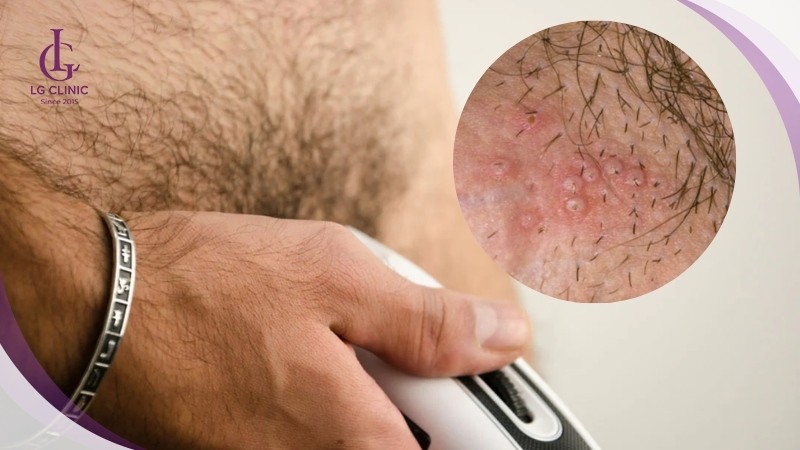cắt tỉa lông vùng kín thường xuyên bị viêm nang lông