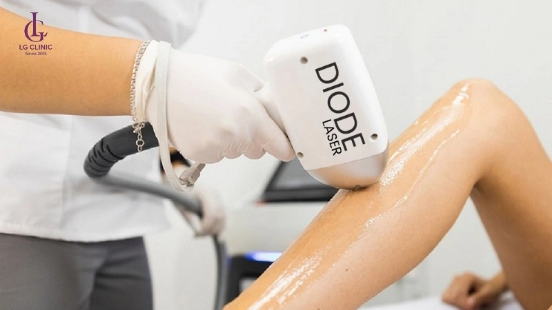 công nghệ triệt lông Diode Laser là gì