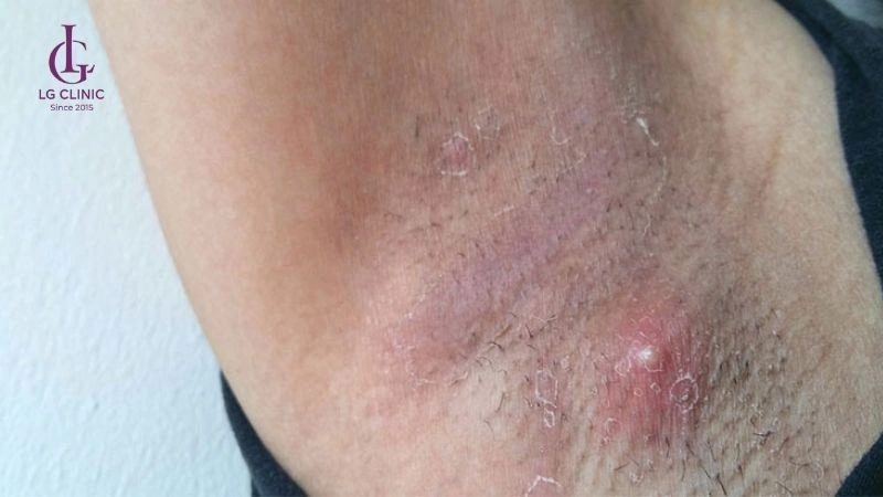 da nách bị sần sùi sau khi nhổ lông
