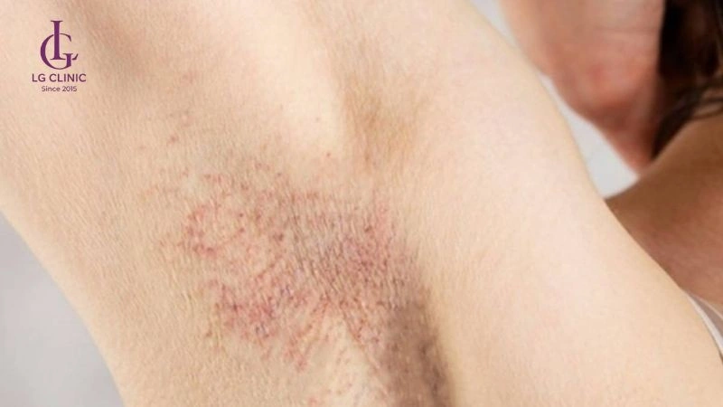 có nên nhổ lông nách không