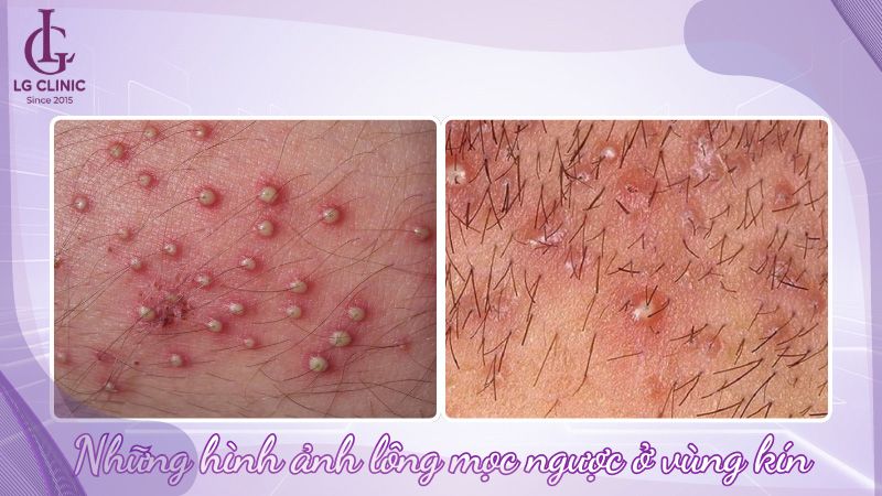hình ảnh lông mọc ngược ở vùng kín