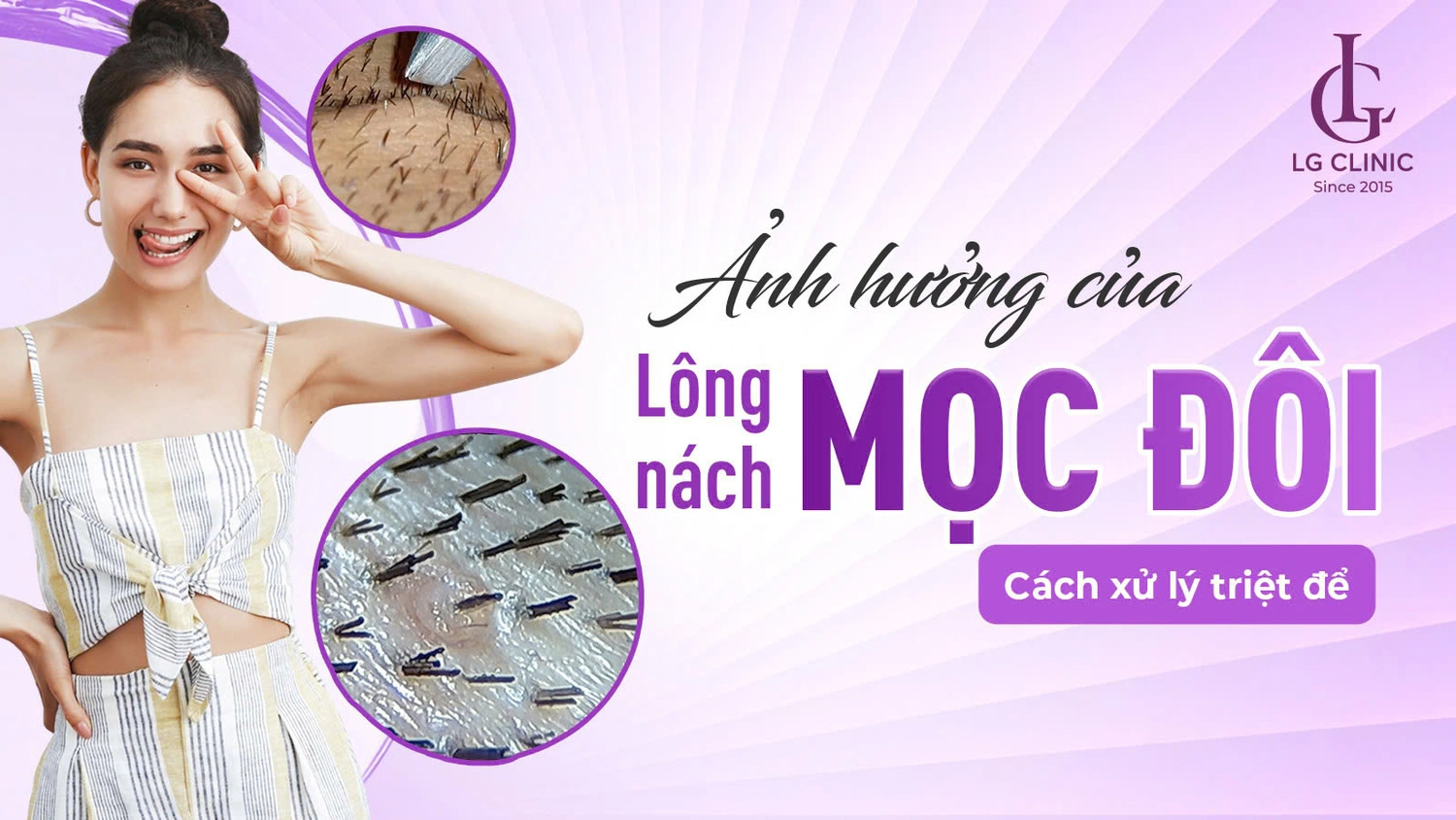 lông nách mọc đôi