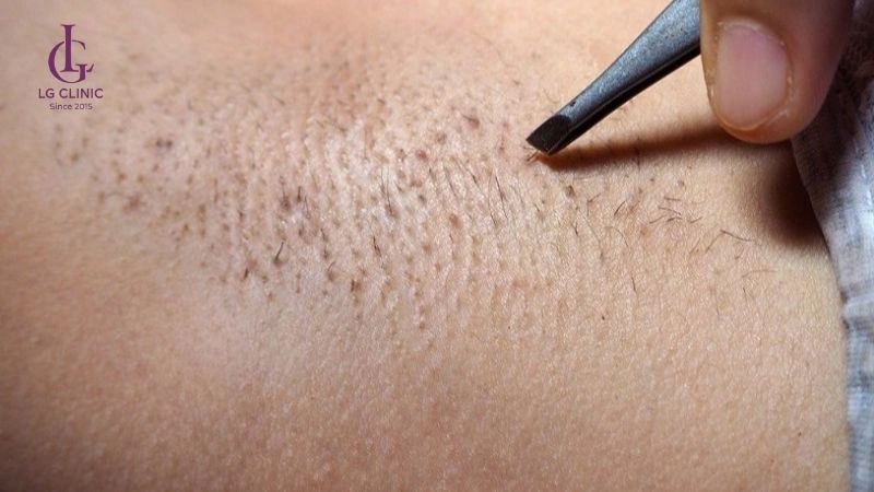 lông nách mọc đôi
