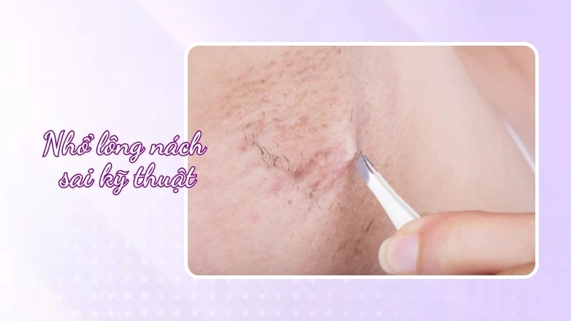 Tại sao nhổ lông nách bị nổi hạch
