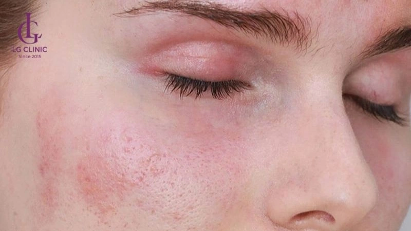 da ửng đỏ sau khi bắn laser trị thâm