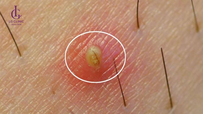 tẩy lông vùng kín cho nam có rủi ro viêm nhiễm