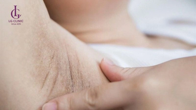 Mỗi lần triệt lông nách cách nhau bao lâu