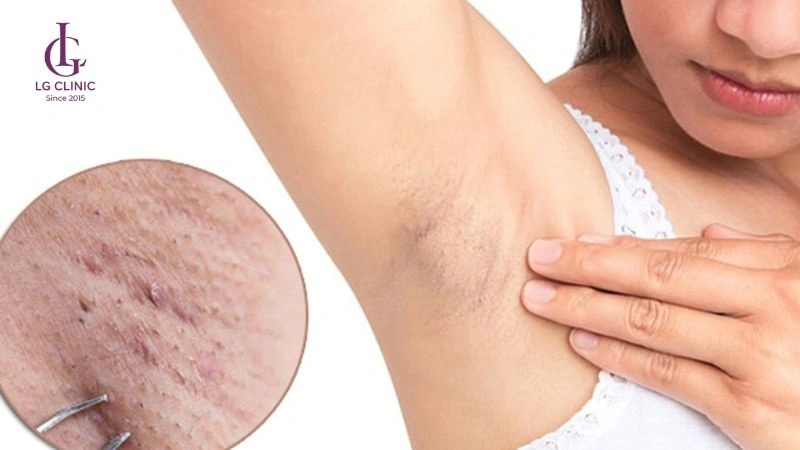 tại sao triệt lông nách lại bị hôi nách