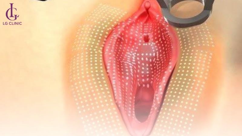 trị thâm vùng kín bằng laser
