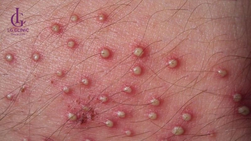 nang lông bị nhiễm trùng