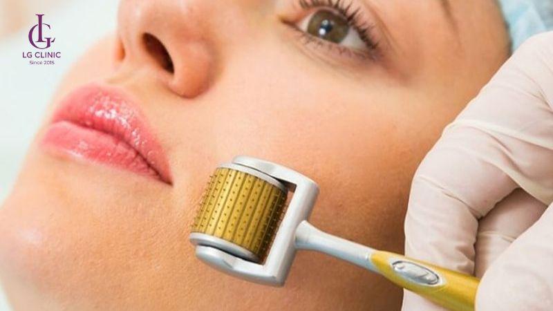 lăn kim trị thâm mụn nặng