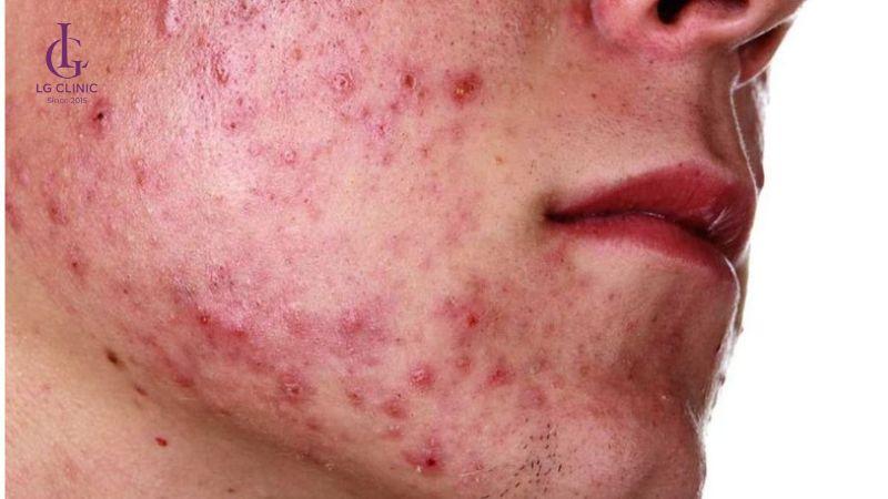 sắc tố melanin là nguyên nhân gây thâm mụn nặng