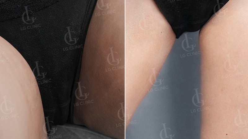 trị thâm bẹn - trị thâm bẹn bằng laser