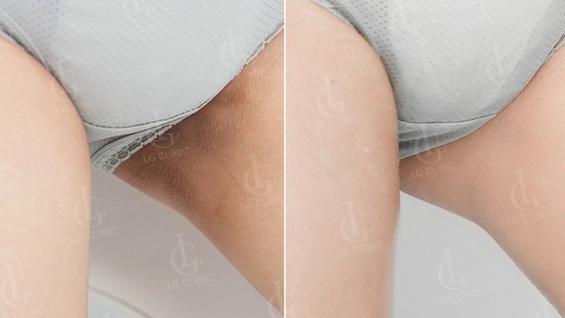 trị thâm bẹn - kết quả điều trị với dịch vụ trị thâm bẹn háng 3