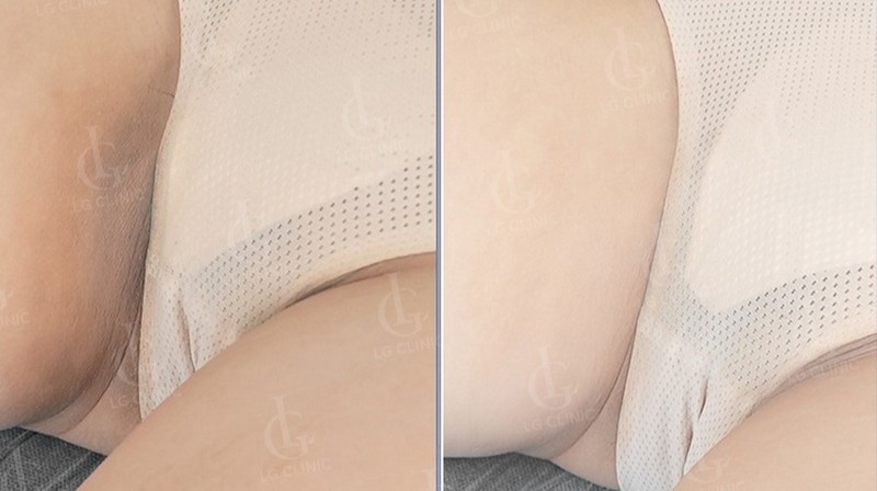 hình trị thâm bẹn háng tại LG Clinic