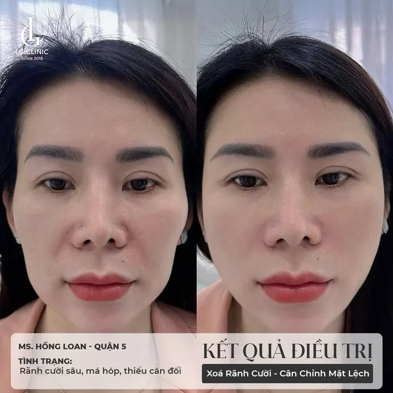 Hình ảnh tiêm bắp meso 2