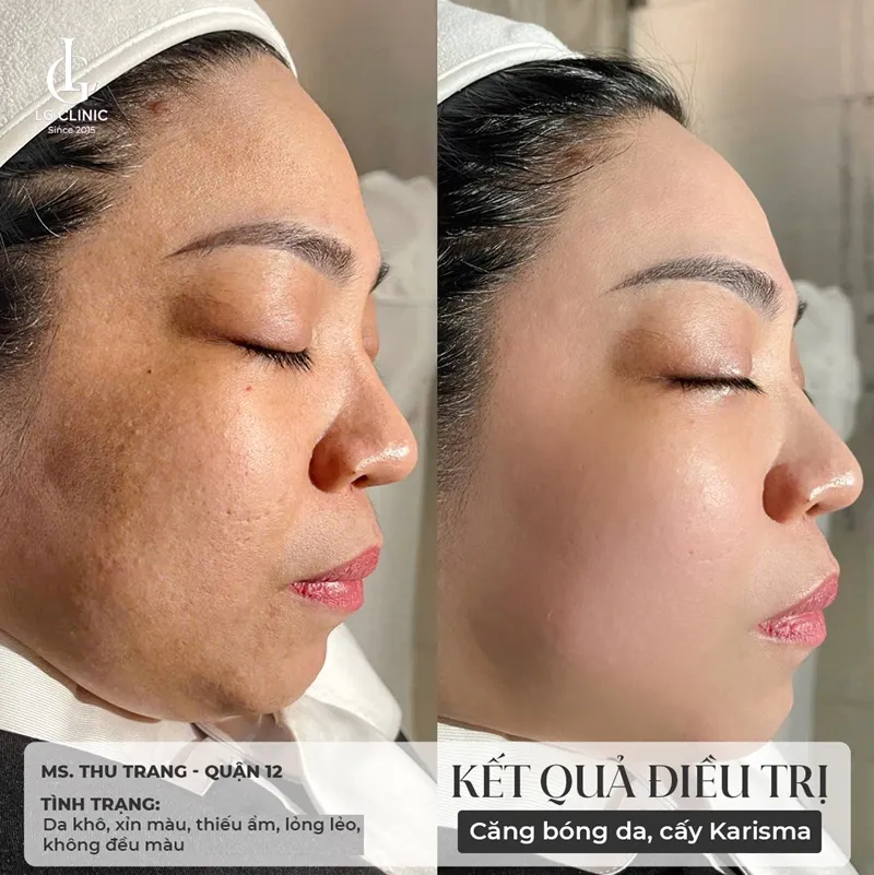 Hình ảnh tiêm bắp meso 3