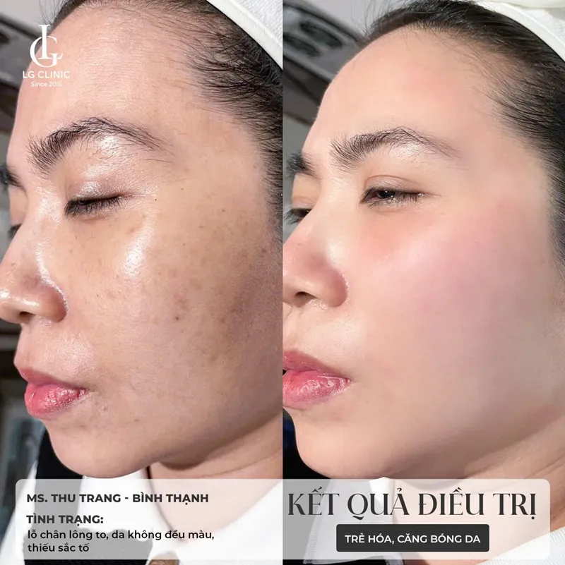 Hình ảnh tiêm bắp meso 4