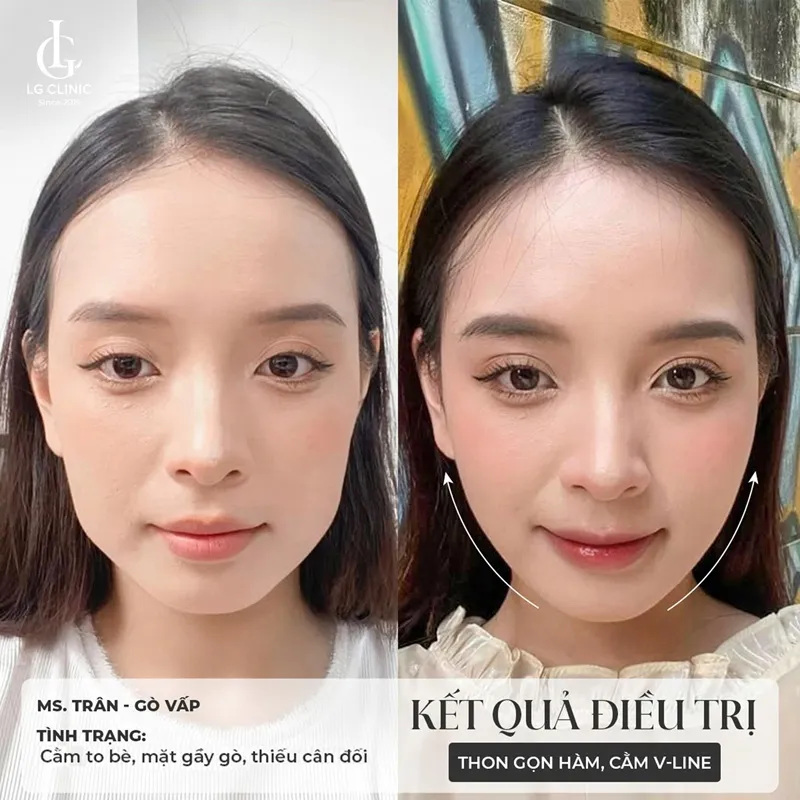 Hình ảnh tiêm bắp meso 6