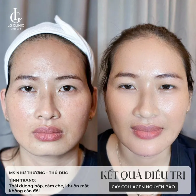 Hình ảnh tiêm bắp meso 7