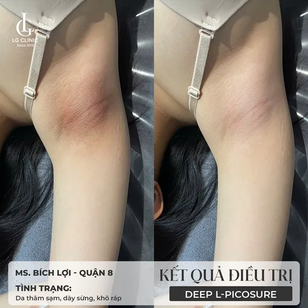 trị thâm bằng laser