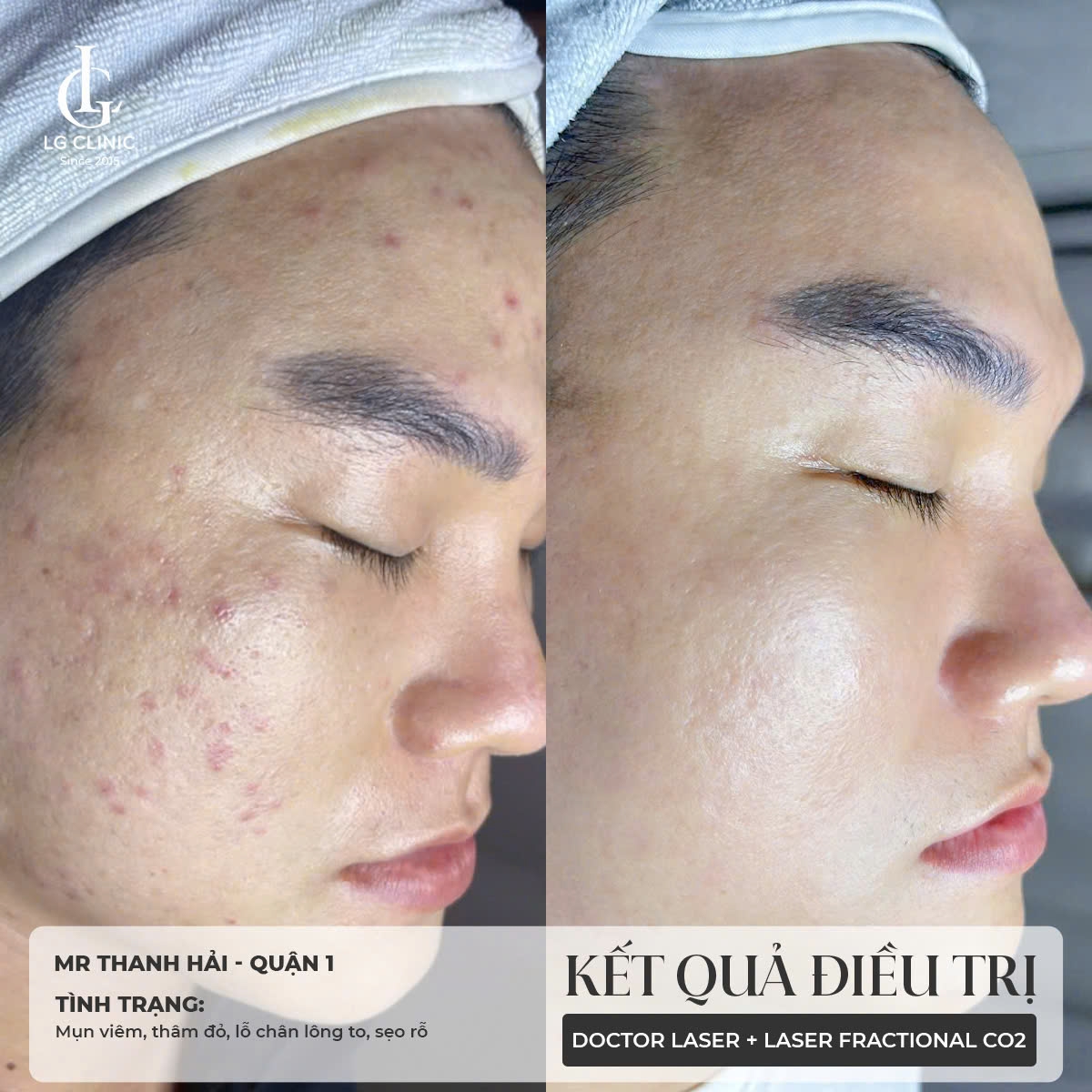 kết quả điều trị thâm mụn 3