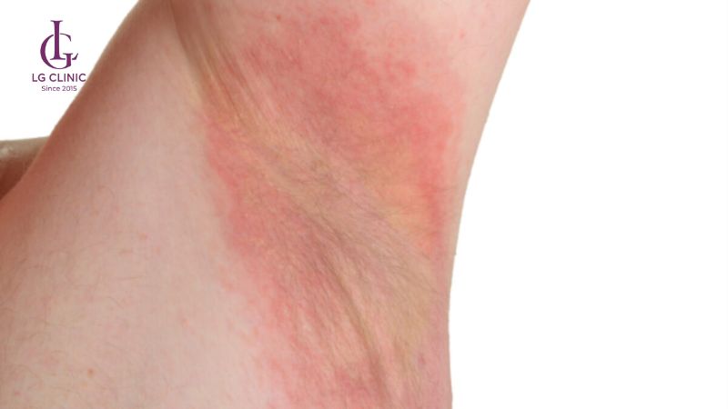 triệt lông bằng laser sai cách có thể gây rát da