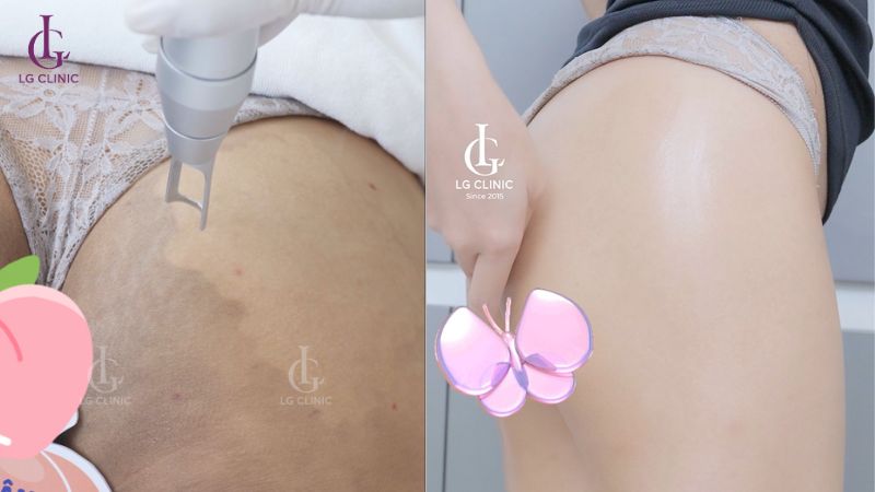 cách trị thâm mông cấp tốc - trị thâm mông bằng laser