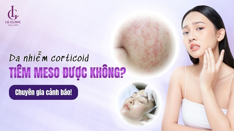 Da nhiễm corticoid có tiêm meso được không