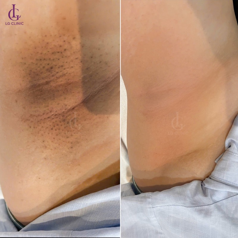 trị thâm nách nam