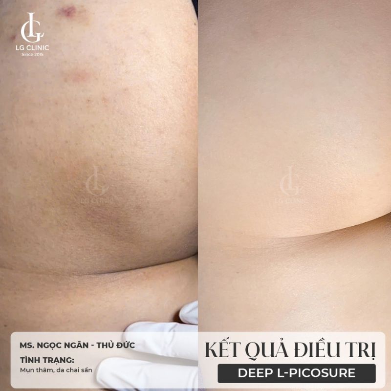 hình ảnh trị thâm mông bằng laser