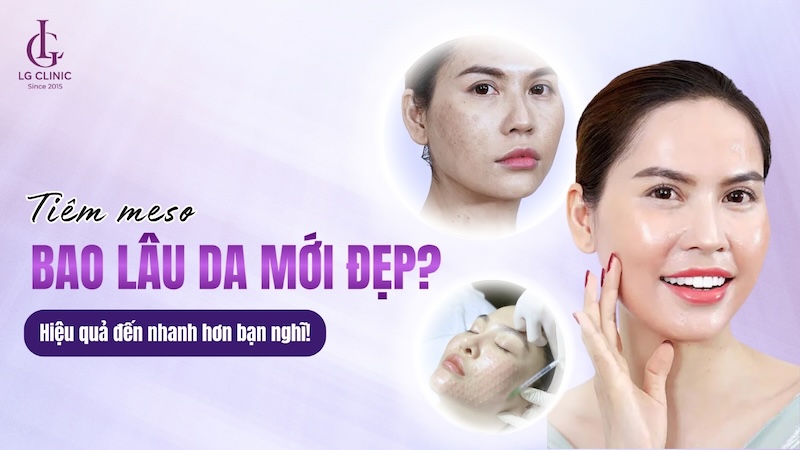 sau tiêm meso bao lâu thì đẹp