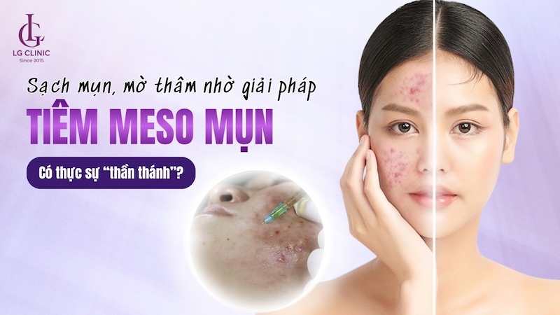 tiêm meso trị mụn