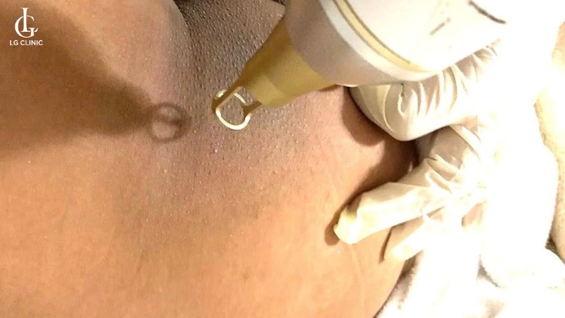 trị thâm mông bằng laser